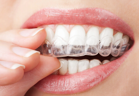 Why do I have to wear a night guard Toothopia