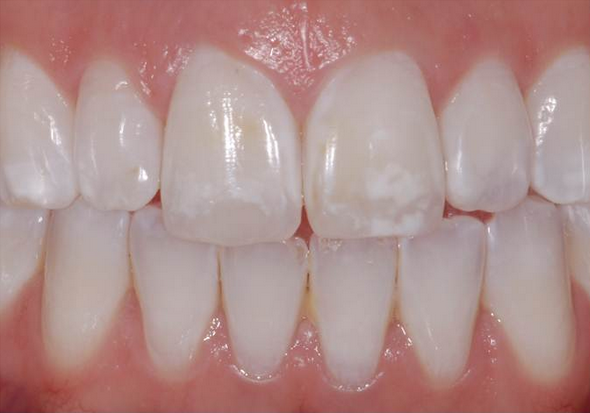 fluorosis